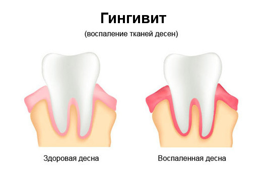 гингивит лечение