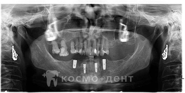 Имплантация зубов