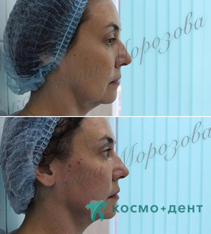 цены на контурную пластику в Красногорске