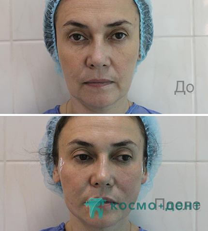 цены на контурную пластику в Красногорске